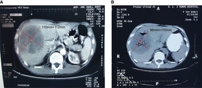 Case report: 10-year survival of a patient with a primary hepatic gastrointestinal stromal tumor